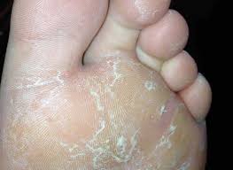 Athlete's foot case 3